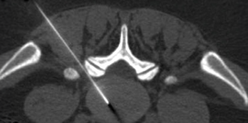 CT and Fluoroscopy guided Interventions